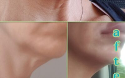 Neck Anti-aging For Lose Skin