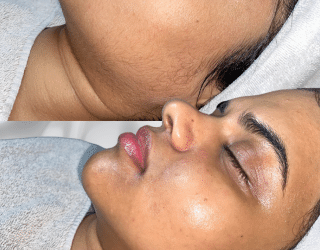 Dermaplaning Facial