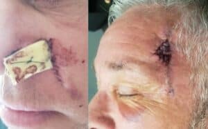 pictures of skin cancer on the face 