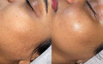 Dermaplaning Facial