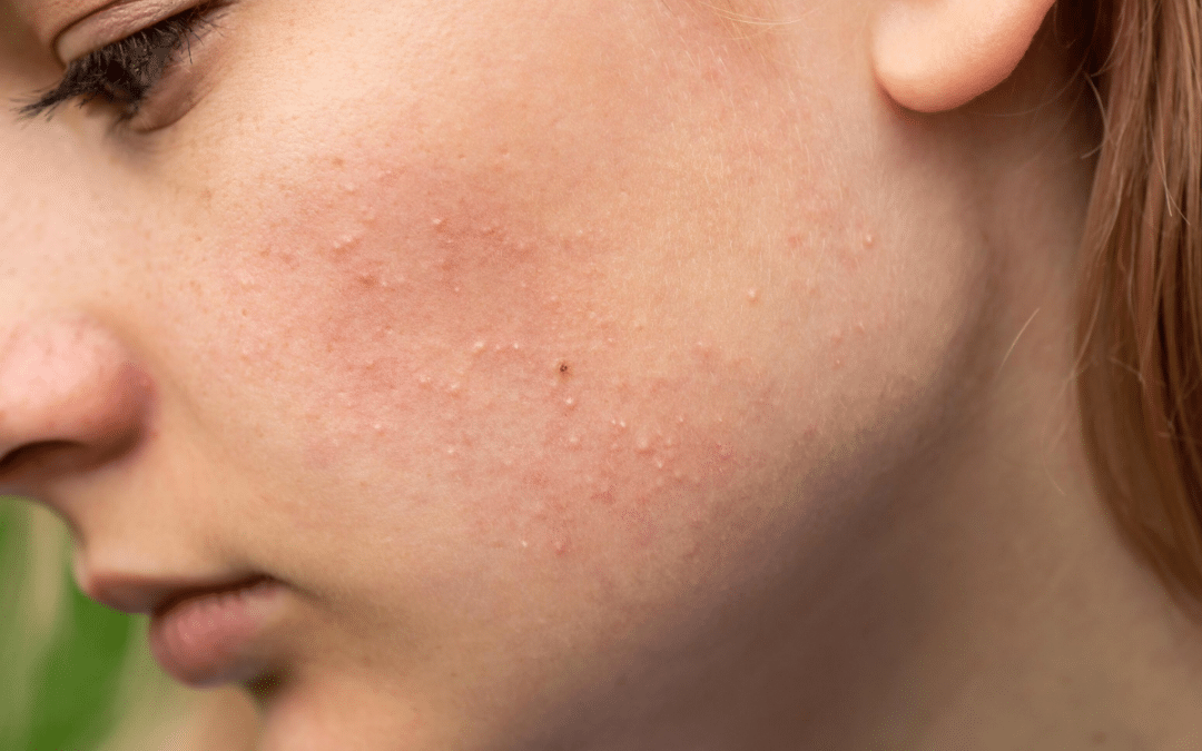 What are these tiny white bumps on my skin?