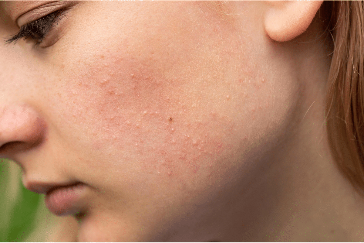hyperkeratosis cover photo What are these tiny white bumps on my skin?